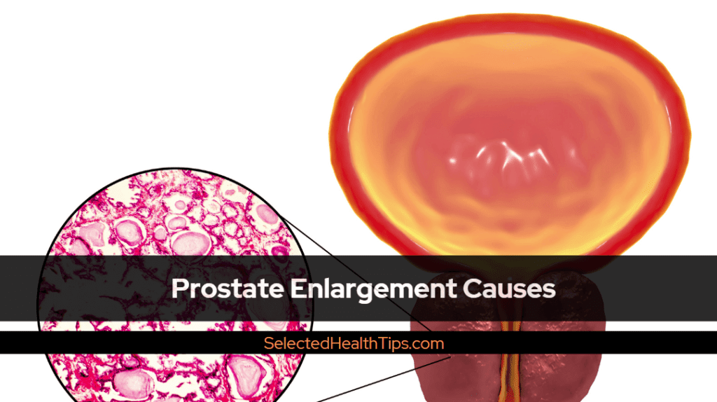 Prostate Enlargement Causes