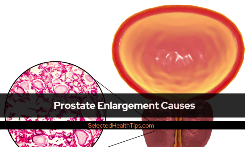Prostate Enlargement Causes