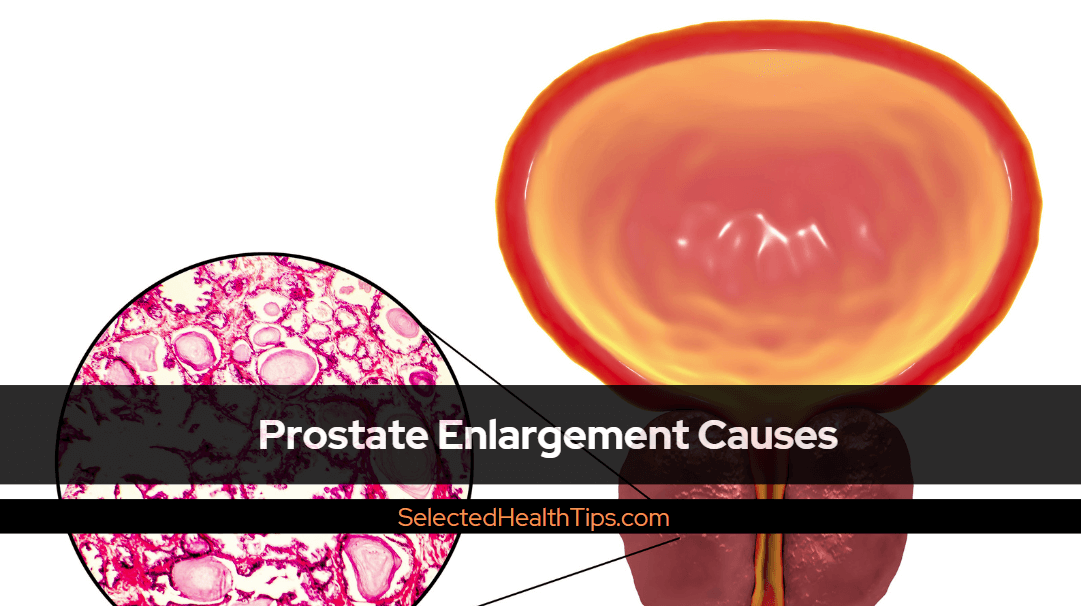 Prostate Enlargement Causes: Understanding The Underlying Factors 